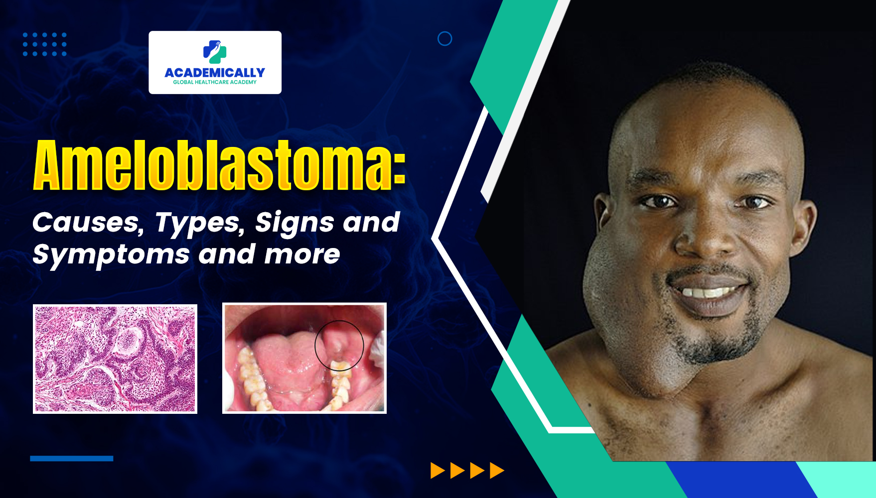 Ameloblastoma