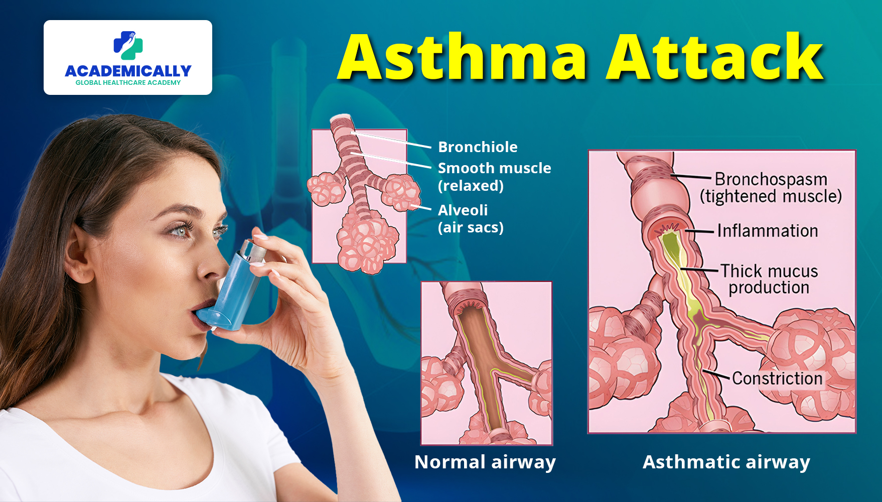 Asthma For APC Exam Preparation